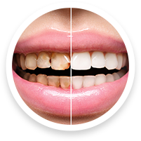 cosmetic dentists in hoover al for dental bonding