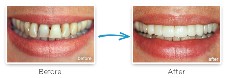 porcelain veneers before and after photos 2