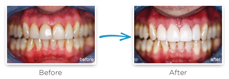 porcelain veneers before and after photos 3